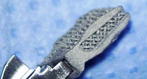 德國首例3D打印鈦脊柱成功融合植入手術(shù)